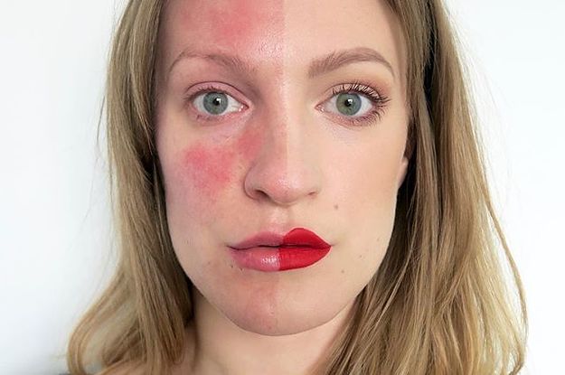 Rosacea-2