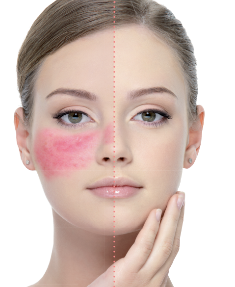 rosacea-00